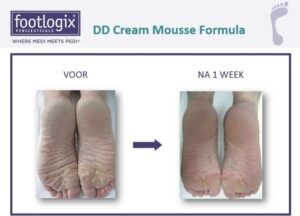 Footlogix DD Cream Mousse result