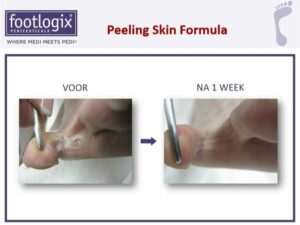 Footlogix Peeling Skin Formula voor na