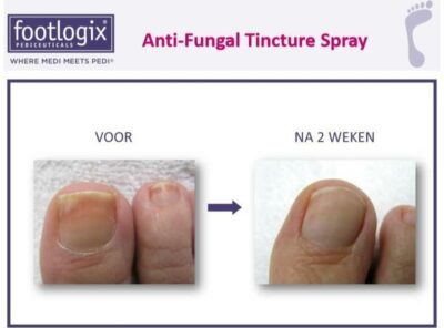 Footlogix Toe Nail Tincture voor na