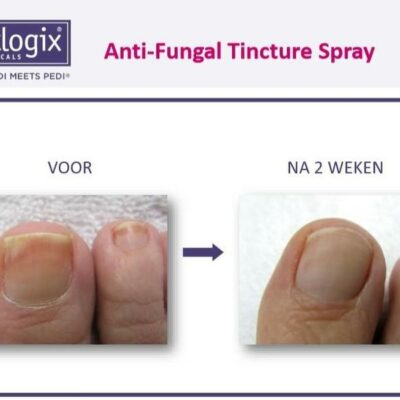 Footlogix Toe Nail Tincture voor na
