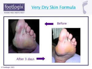Footlogix Very Dry Skin Formula before en after