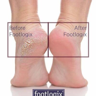 Footlogix before after