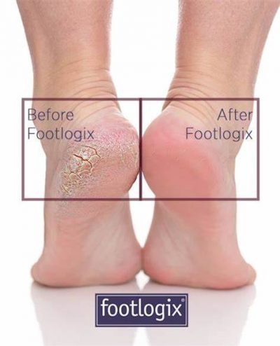 Footlogix before after